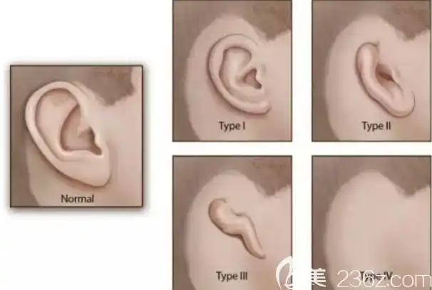 韩国普罗菲耳profile整形医院治疗各种耳朵畸形 耳廓耳道可一起做