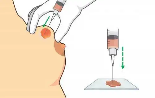 乳腺结节示意图(来自网络)在门诊中,很多患者在听说乳腺穿刺活检很不