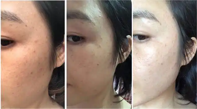 46岁周迅因长斑崩溃痛哭美白祛斑这款国货之光来帮你