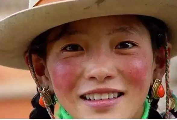 脸部高原红的护理建议