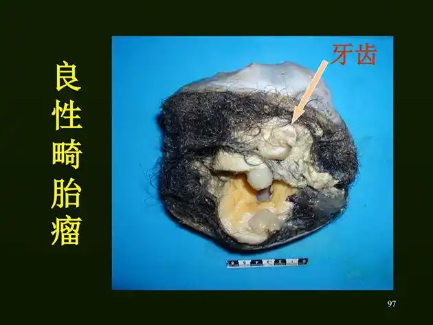 生物嵌合体身体中另一个他