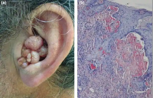 这样的外耳道结节你能诊断吗