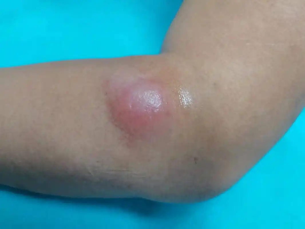 这个是淋巴造血系统恶性肿瘤的皮肤表现.#超声影像 #迈瑞医疗 - 抖音