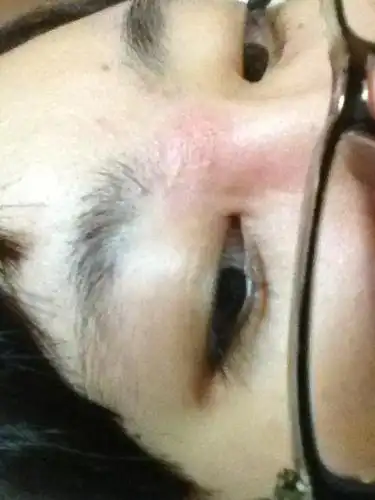 脸上不知道是湿疹还是过敏了!