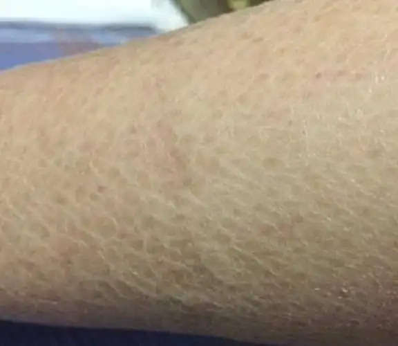 腿上皮肤干燥像鱼鳞怎么治疗告诉你个巧方法