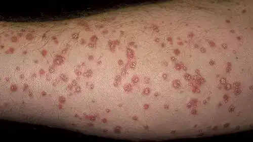 青少年银屑病图片及症状图片_银屑病求医网