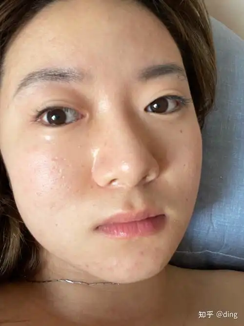 皮肤屏障受损怎么修复比较安全? - 知乎