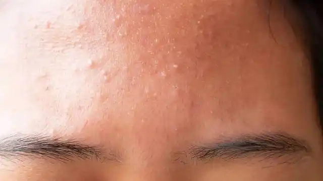 毛孔堵塞什么样子的图片,脸上毛孔堵塞症状(油皮必看:手把手教你消灭