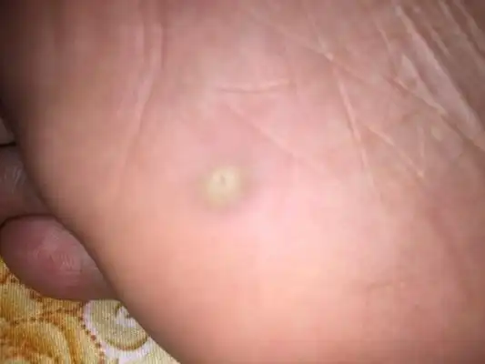 脚底长了个硬疙瘩图7