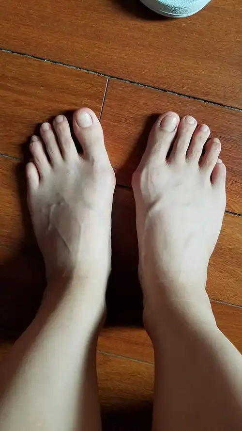 女生脚趾拇外翻是什么样体验