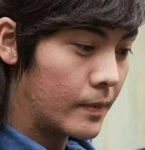 睡眠不足再加上油性皮肤导致痘痘爆发,满脸的坑坑洼洼,有密集恐惧症的