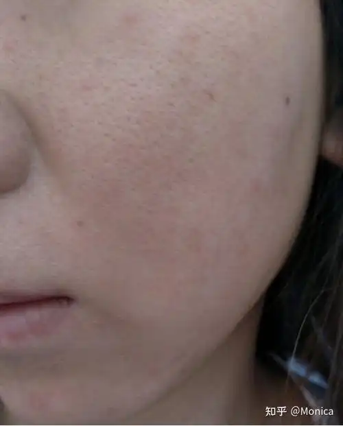 很多人在夏季的时候脸蛋一直出油以及毛孔粗大夏季出油毛孔粗大怎么办