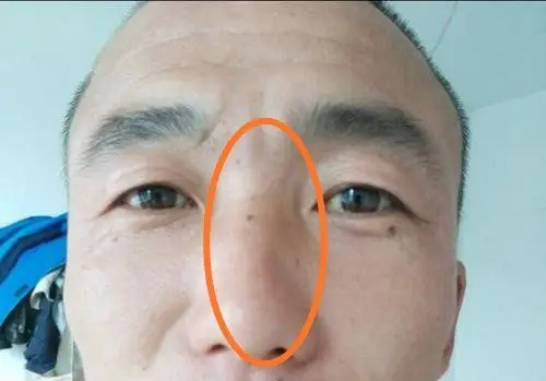 男人山根有痣又称作「双凤朝阳」,代表容易陷入三角关系,除非命主能