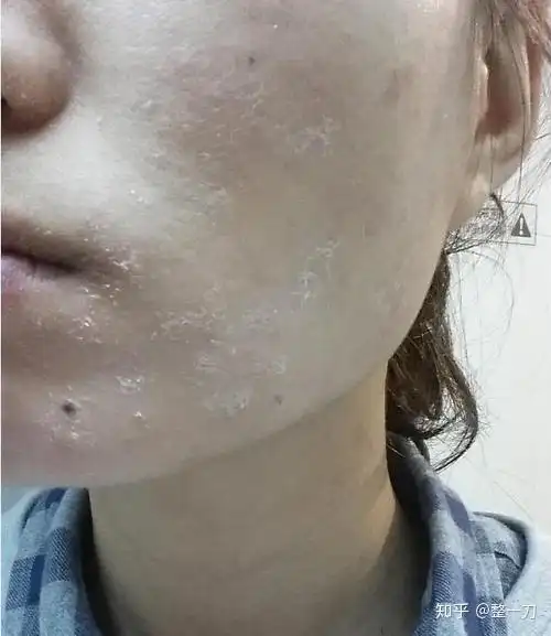 化妆品过敏后的不良症状有哪些呢