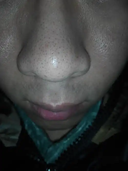 我这样的黑头鼻子还有救吗?_百度知道