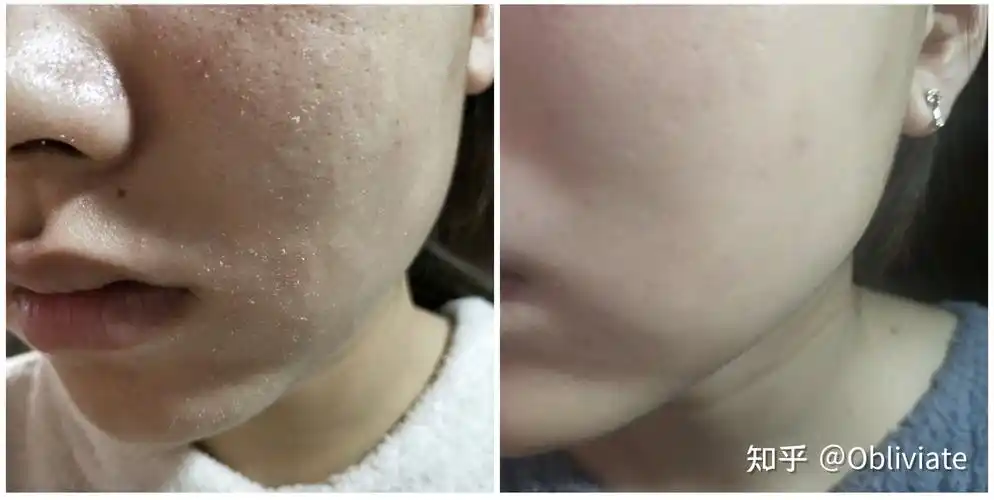 脸上经常干燥脱皮,起皮脱屑,还敏感怎么办?