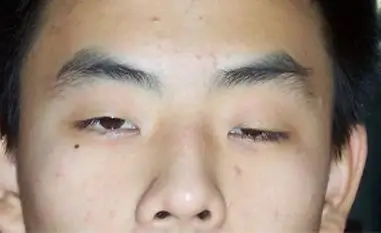 一般眼睑下垂者