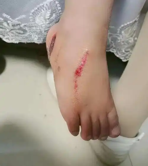 把小女孩送到附近的一家诊所进行冲洗.脚面上挂了很大的一道口子.