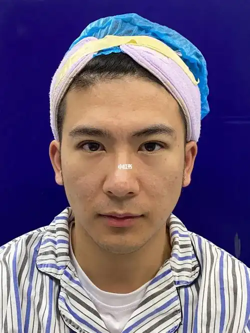 男生做双眼皮第一天