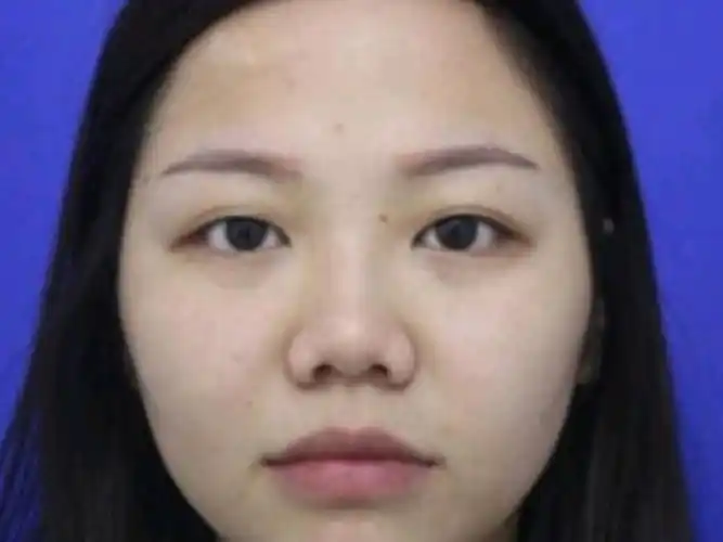 我的鼻翼大是我一直困扰的问题,观望了很久,不知道是_圈子-新氧美容