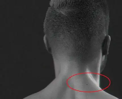 男人脖子有这几种痣35岁之后富贵临身身家千万