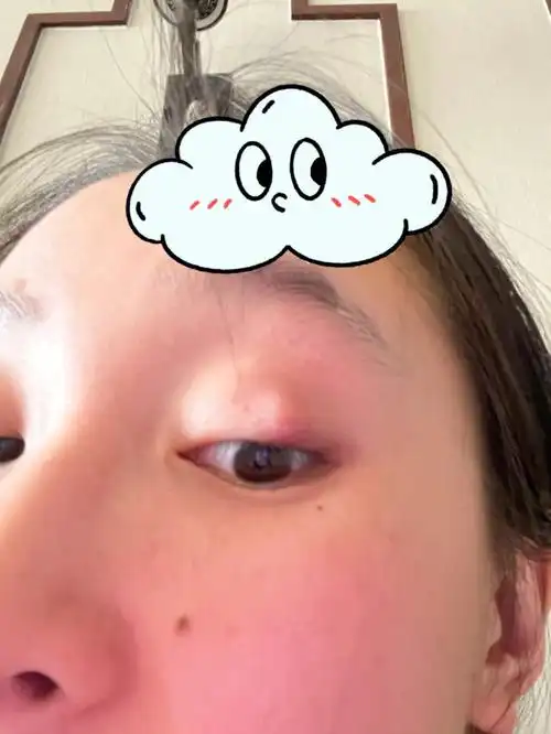 第二次长霰粒肿,这次取用老祖宗的智慧治疗