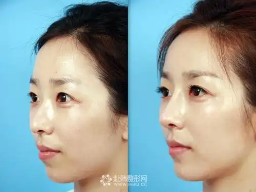 假体隆鼻的三种方式垫高你的塌鼻子