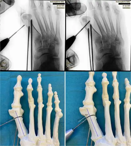 早读 | 手把手教你拇外翻矫形术:第3代mica手术技术