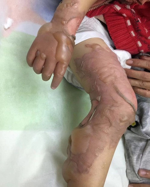 小儿烫伤莫慌张,谨记五步急救法