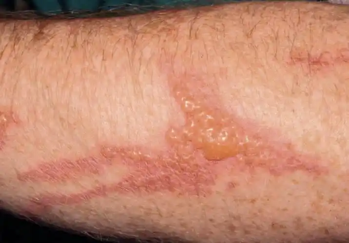 小儿接触性皮炎