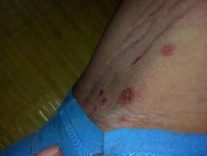 大腿外侧股癣 图片_有来医生