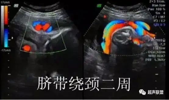 青海省康乐医院超声科提醒您警惕脐带绕颈对胎儿的不良影响