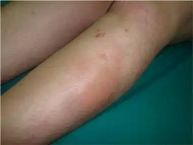 病案狼疮性脂膜炎一例