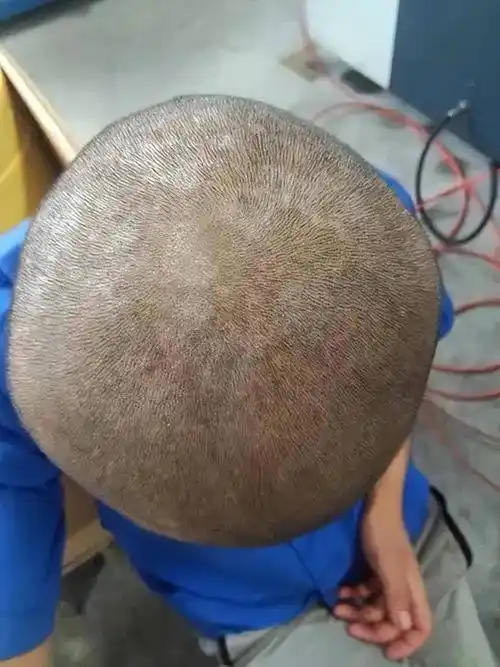 「杏林微科普」头皮屑增多,可能是银屑病复发或加重的征兆