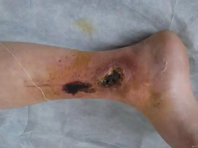 胫骨骨折术后部分皮肤坏死