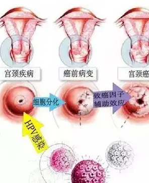 女人如果出现了这5种症状,小心是早期宫颈癌,子宫才是女人资本_生育