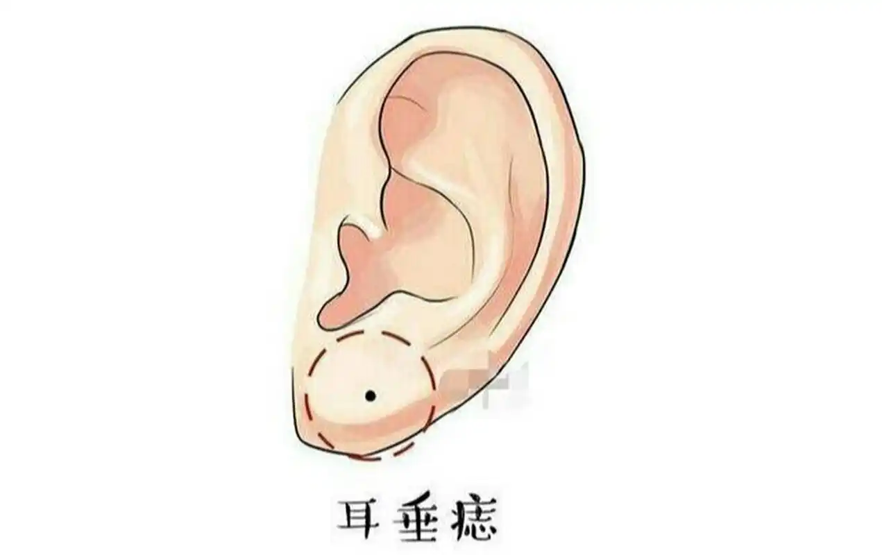 耳垂有痣运事 就男人而言,耳垂饱满有痣的人偲运好,事业上能得贵人