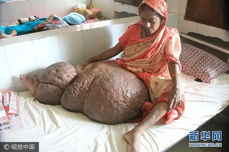 孟加拉国40岁女子患象皮病|象皮病|母亲-天下图库_华商网新闻