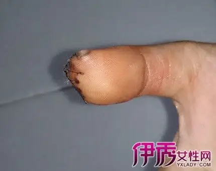 【图】解密手术后拆线疼吗 小编提醒患者必须注意的拆线时间