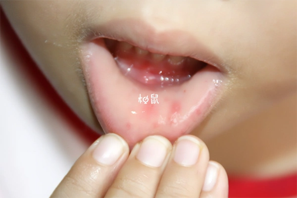 小孩手足口病轻微图片,教你尽早辨别疾病显象 - 柚鼠知识