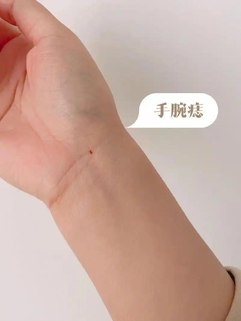 长大了发现痣也长大 	 这个痣一直挺喜欢的,看着顺眼 	 大师说手腕痣