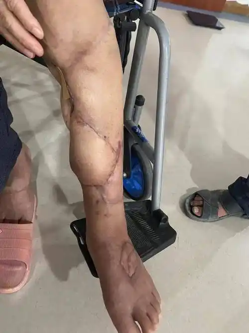 截肢?不可能!骨科这样保住了宋阿姨的腿