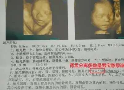 想要小棉袄的孕妈,b超单上经常出现这3种情况,美梦可能要成真了_宝宝