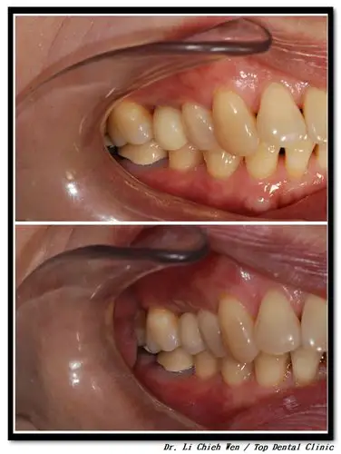 拔牙 立即植牙 补骨 - 05(右上小臼齿完成)