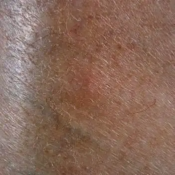 医学研究表明:糖尿病患者有时的血糖低以及身体脱水,可能会引发皮肤干