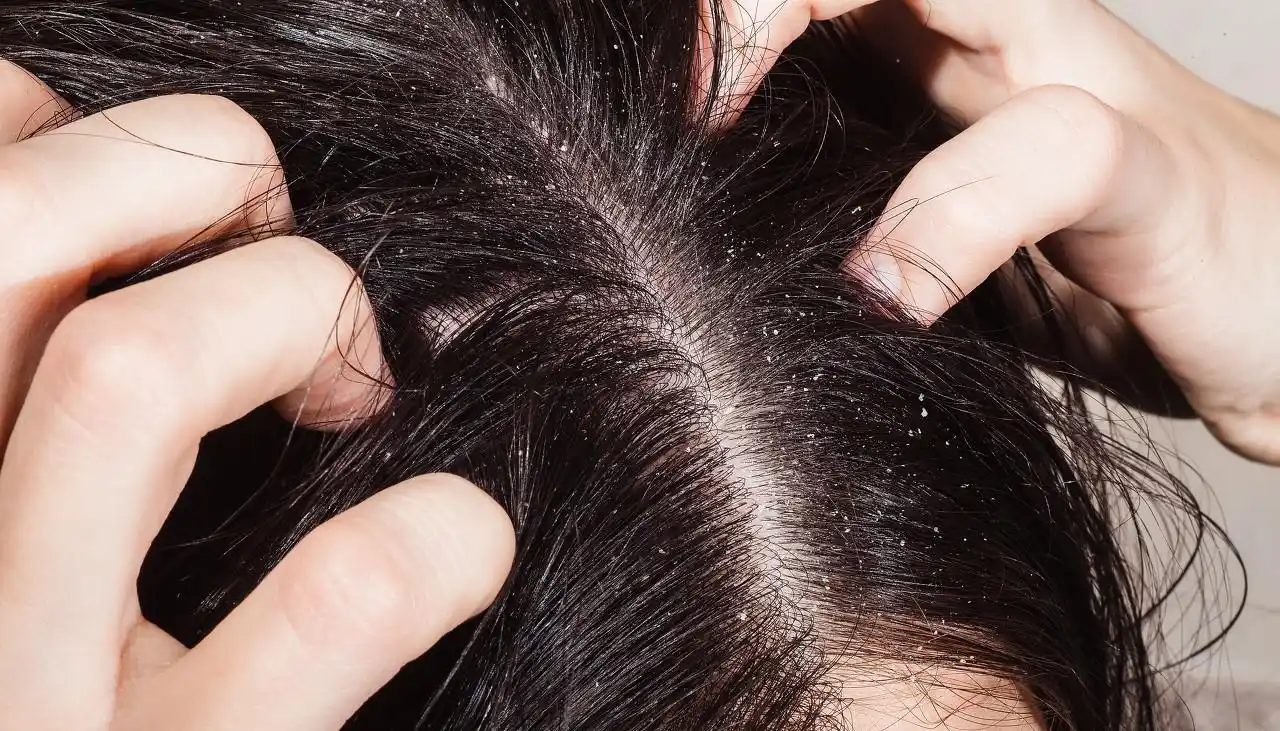 头皮痒,还能抠下灰泥,可能头上螨虫成窝,教你逼退螨虫3妙招