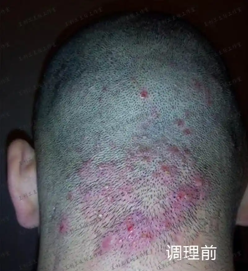 头上毛囊炎疙瘩又疼又痒,中医1个方子帮改善!