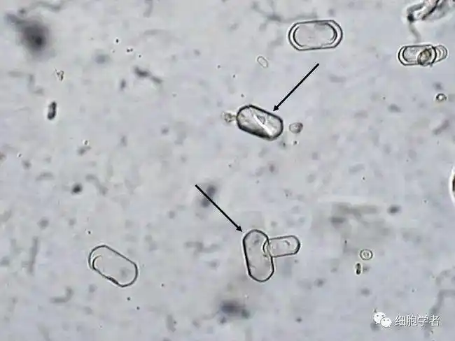 oxalate crystal 属生理性结晶,多因摄入植物性食物产生,正常情况可见