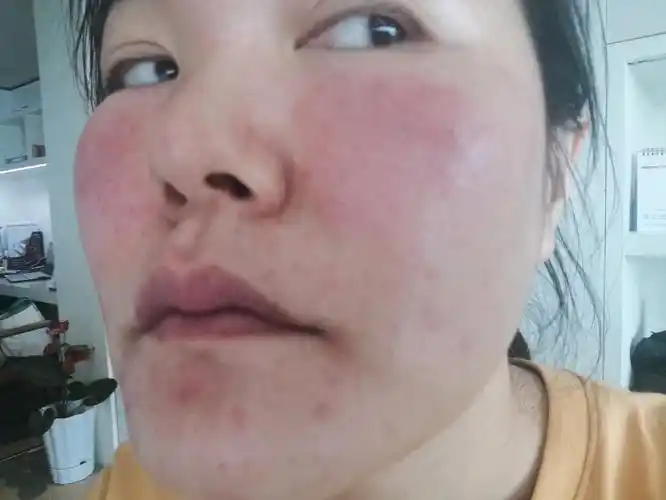 皮肤严重过敏红肿胀