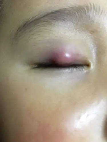 小孩霰粒肿一个月了求支招